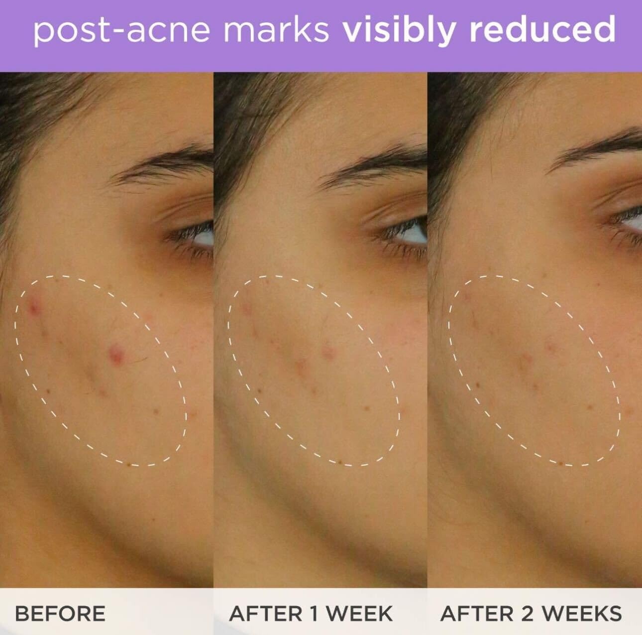 image:imageThe Brightening Serum Vitamin C Treatment for Brighter Firmer Skin Targets Hyperpigmentation amp Fades PostAcne Marks 30 ml 10 fl oz
